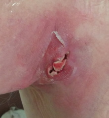 Cyst packed with gauze 2