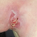 Cyst packed with gauze 1