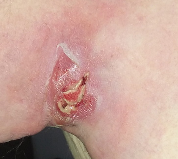 Cyst packed with gauze 1